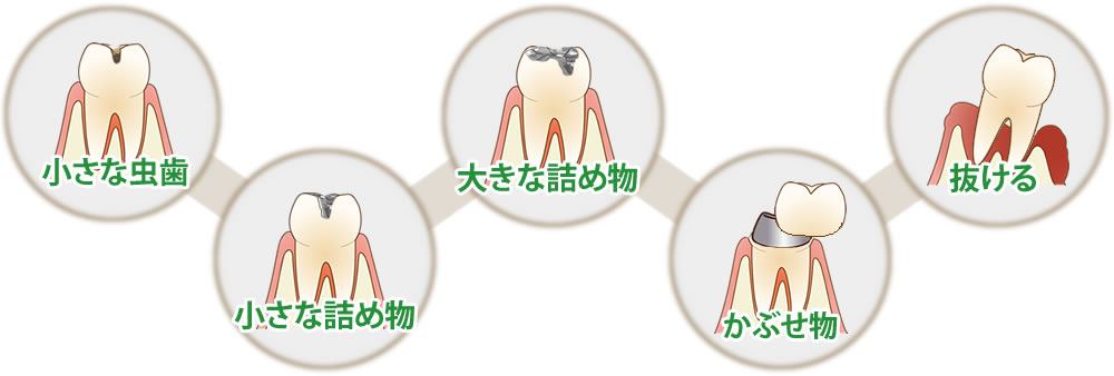 小さな虫歯から小さな詰め物になり、大きな詰め物、被せものにそして最後には抜ける